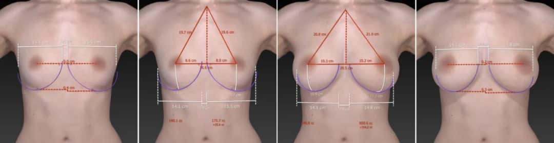 Ile kosztuje powiększanie biustu? Zrozum, co wpływa na ceny zabiegu