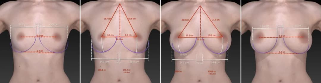 Ile kosztuje powiększanie biustu? Zrozum, co wpływa na ceny zabiegu