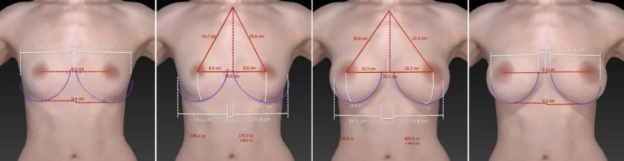Ile kosztuje powiększanie biustu? Zrozum, co wpływa na ceny zabiegu