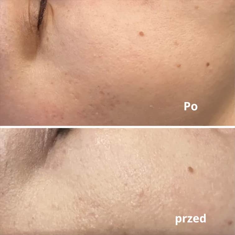 Kiedy makijaż po laserze frakcyjnym? Bezpieczne terminy i zasady