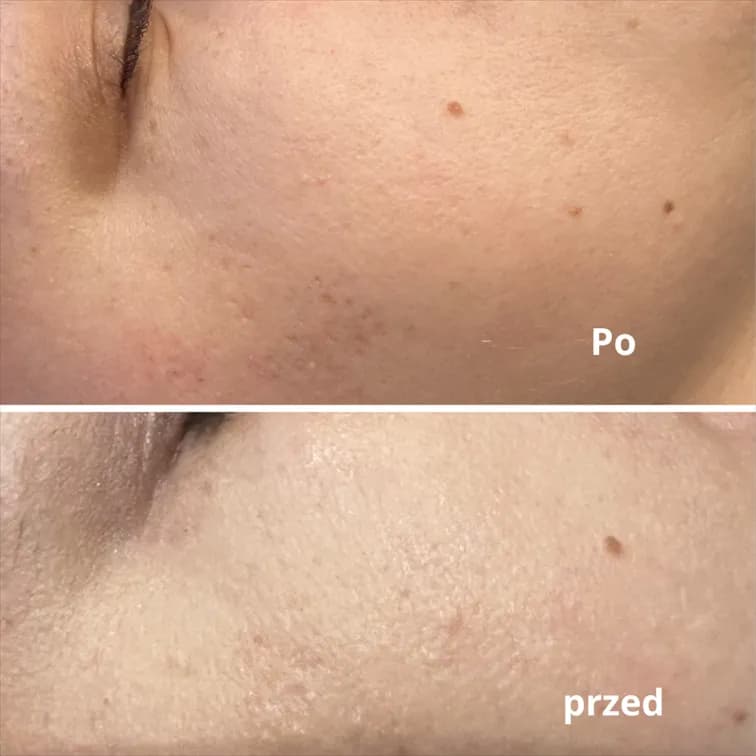 Kiedy makijaż po laserze frakcyjnym? Bezpieczne terminy i zasady