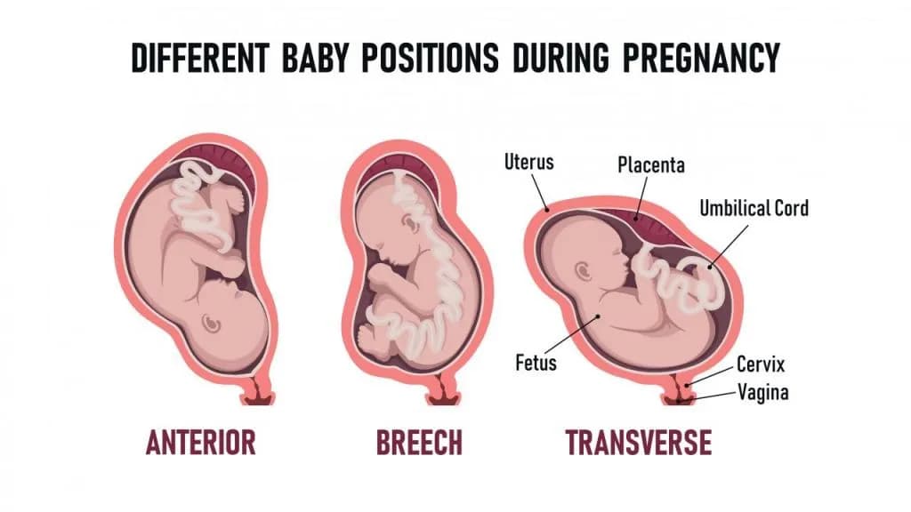 Położenie miednicowe a objawy porodu - co musisz wiedzieć?