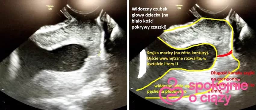 Skrócona szyjka macicy a poród: Kiedy spodziewać się rozwiązania?