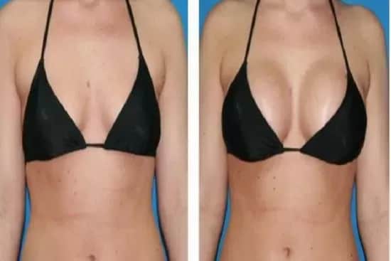 Ile kosztuje powiększenie biustu w Turcji? Ceny i porównanie