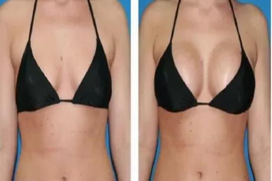 Ile kosztuje powiększenie biustu w Turcji? Ceny i porównanie