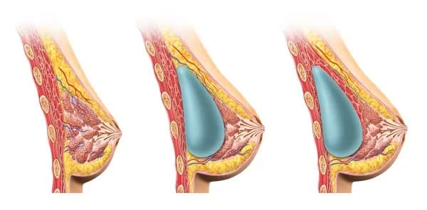 Co jest dobre na powiększenie biustu? Poznaj skuteczne metody naturalne i chirurgiczne